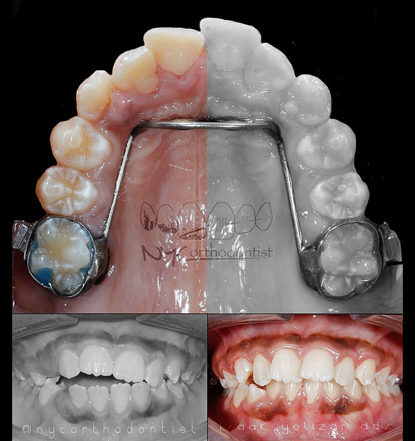 Side by side comparison of smile before and after phase on orthodontics