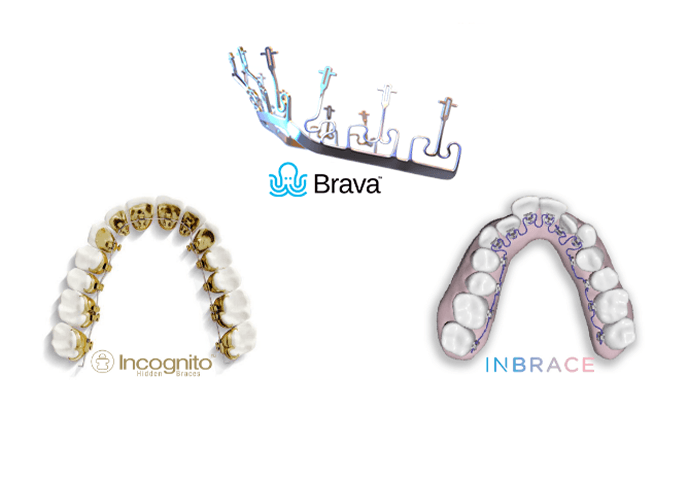 Comparison of different types of hidden braces