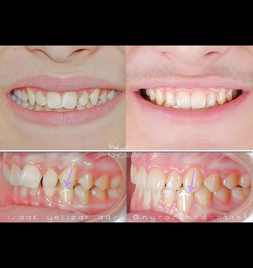 Patient's smile before and after smile arc creation