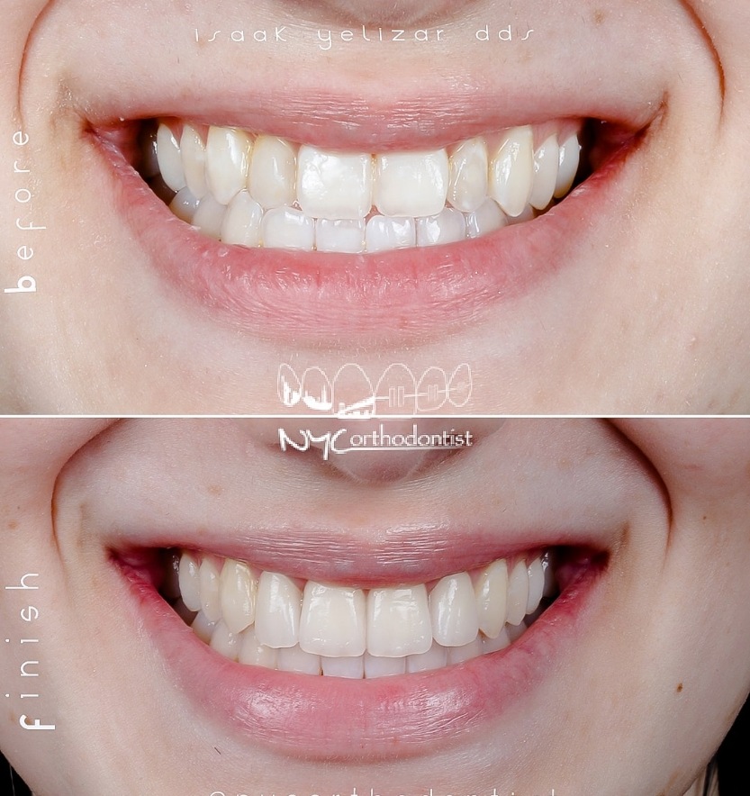 Closeup of smile before and after smile arc creation