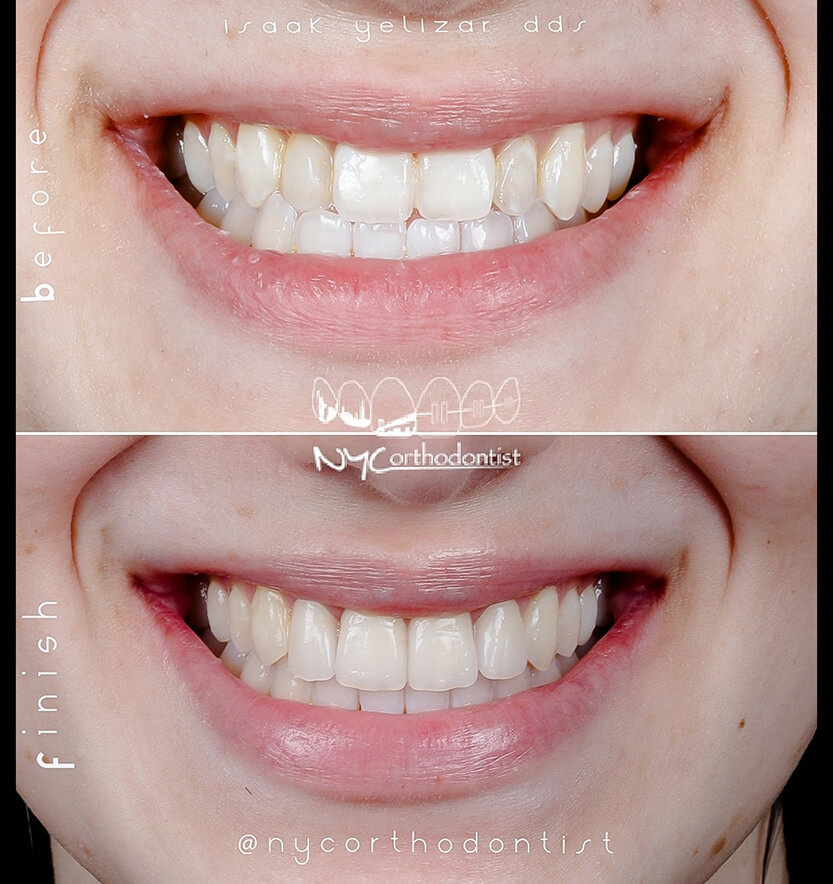 Closeup of smile before and after smile arc creation