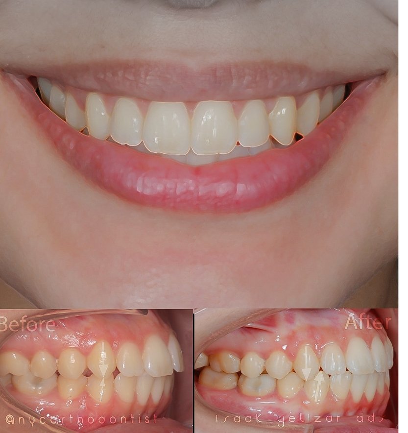 Front and profile view of smile before and after smile arc creation