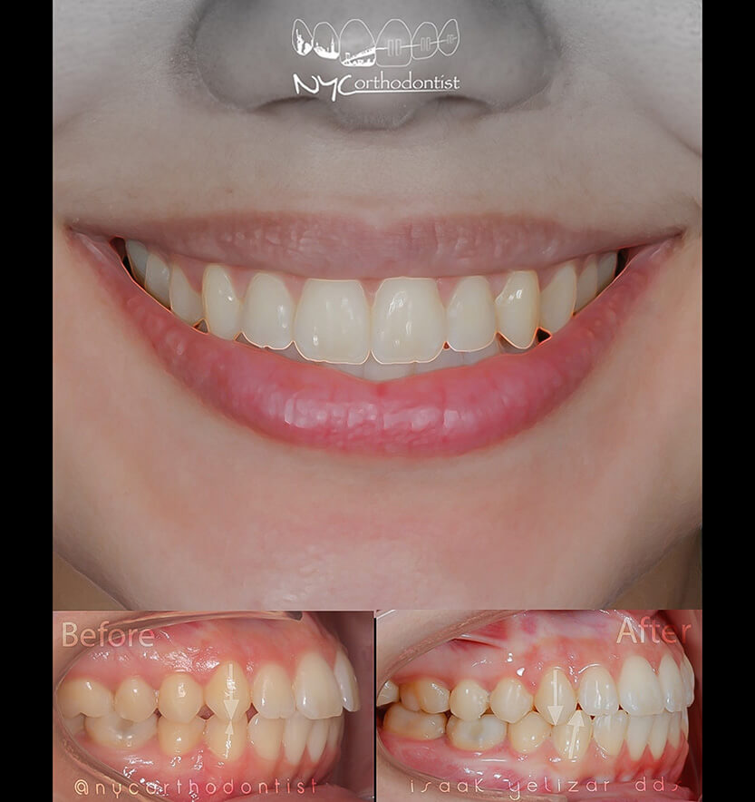 Front and profile view of smile before and after smile arc creation