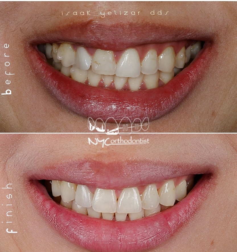 Front view of smile before and after smile arc creation