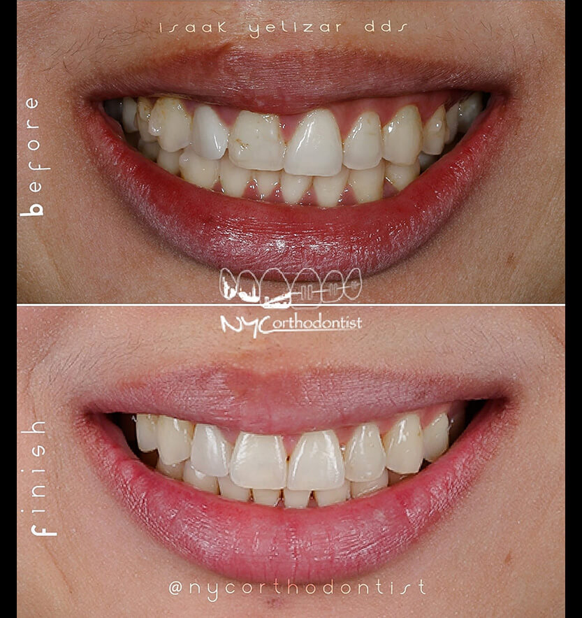 Front view of smile before and after smile arc creation