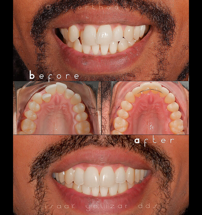 Inside of bite and front of smile before and after smile arc creation