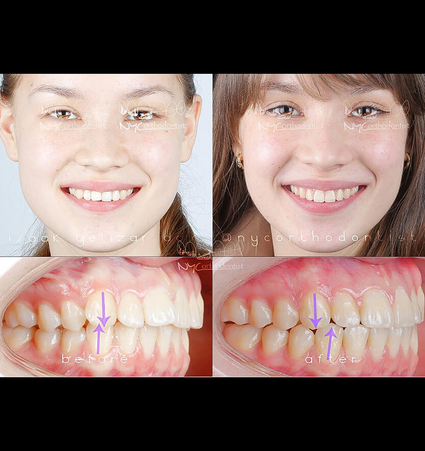 Young patient's smile before and after smile arc creation