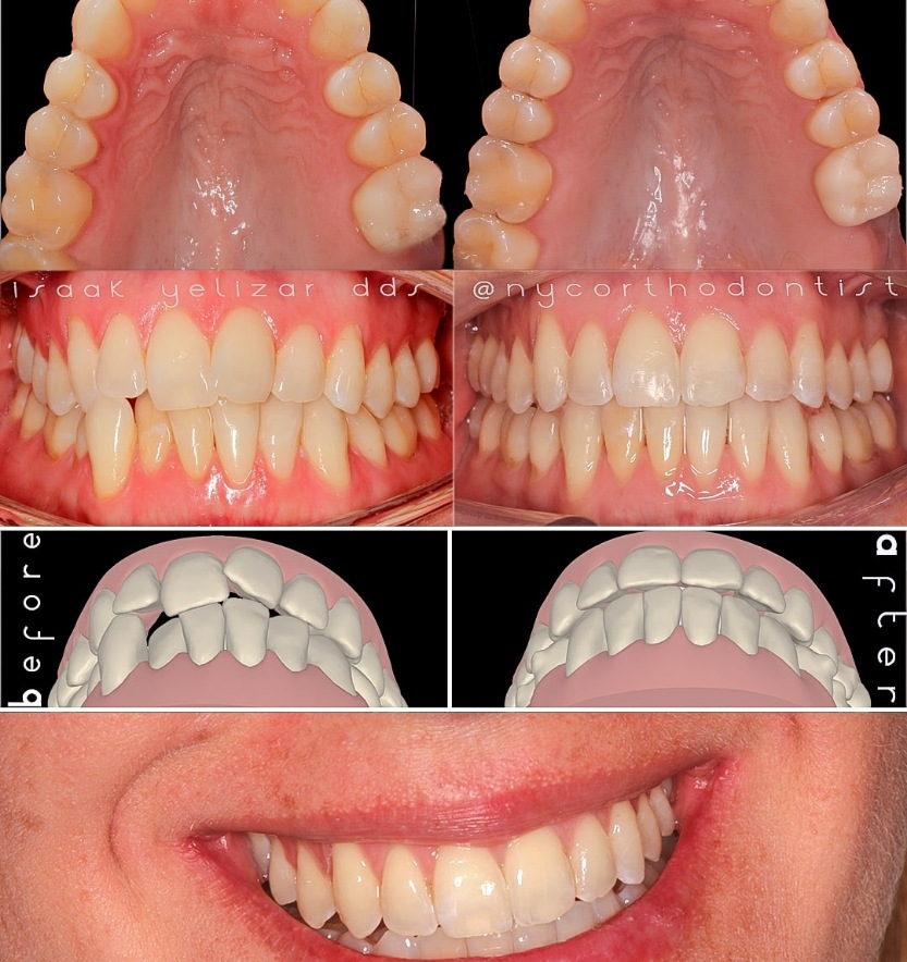 Patient's smile and animated smile design before and aftr smile arc creation