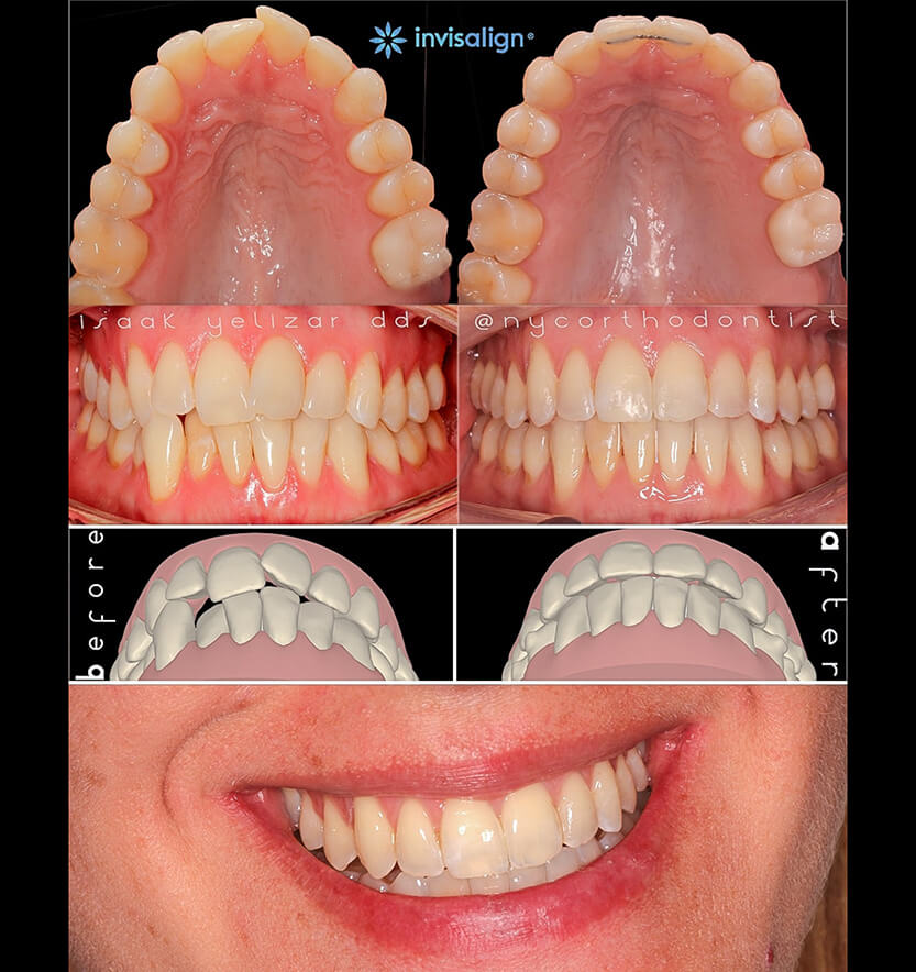 Patient's smile and animated smile design before and aftr smile arc creation