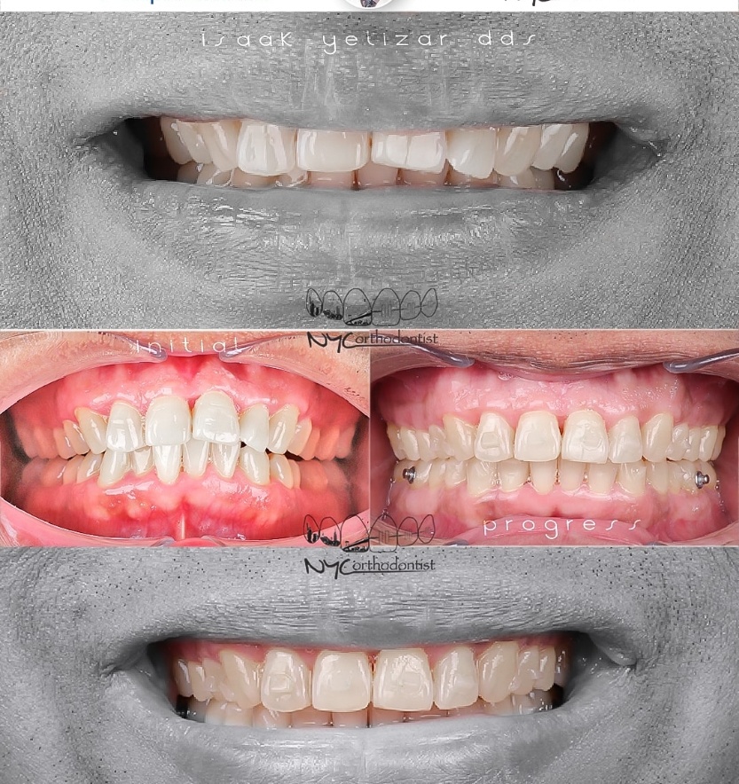 Front of smile before anda after smile arc creation