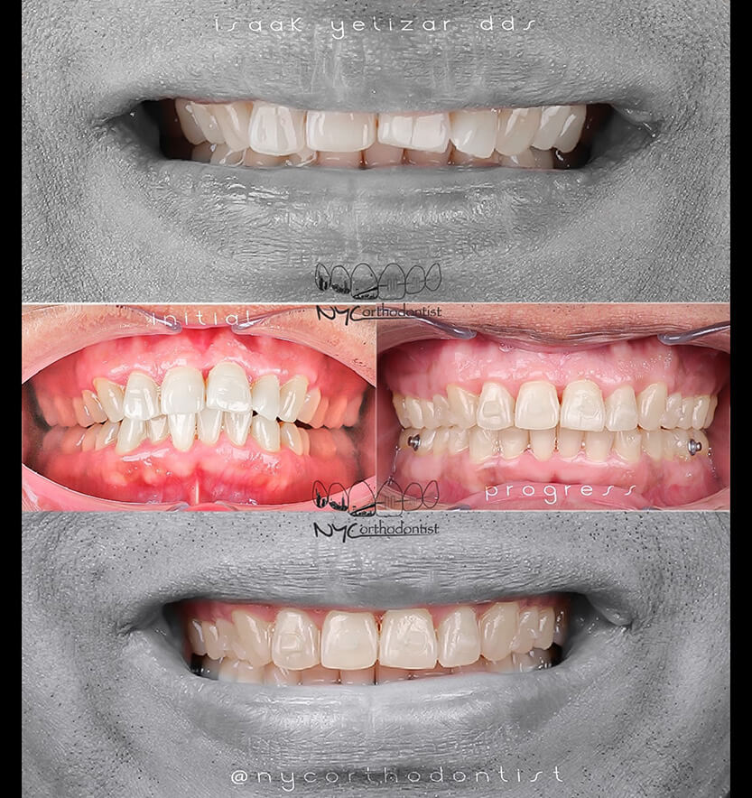 Front of smile before anda after smile arc creation