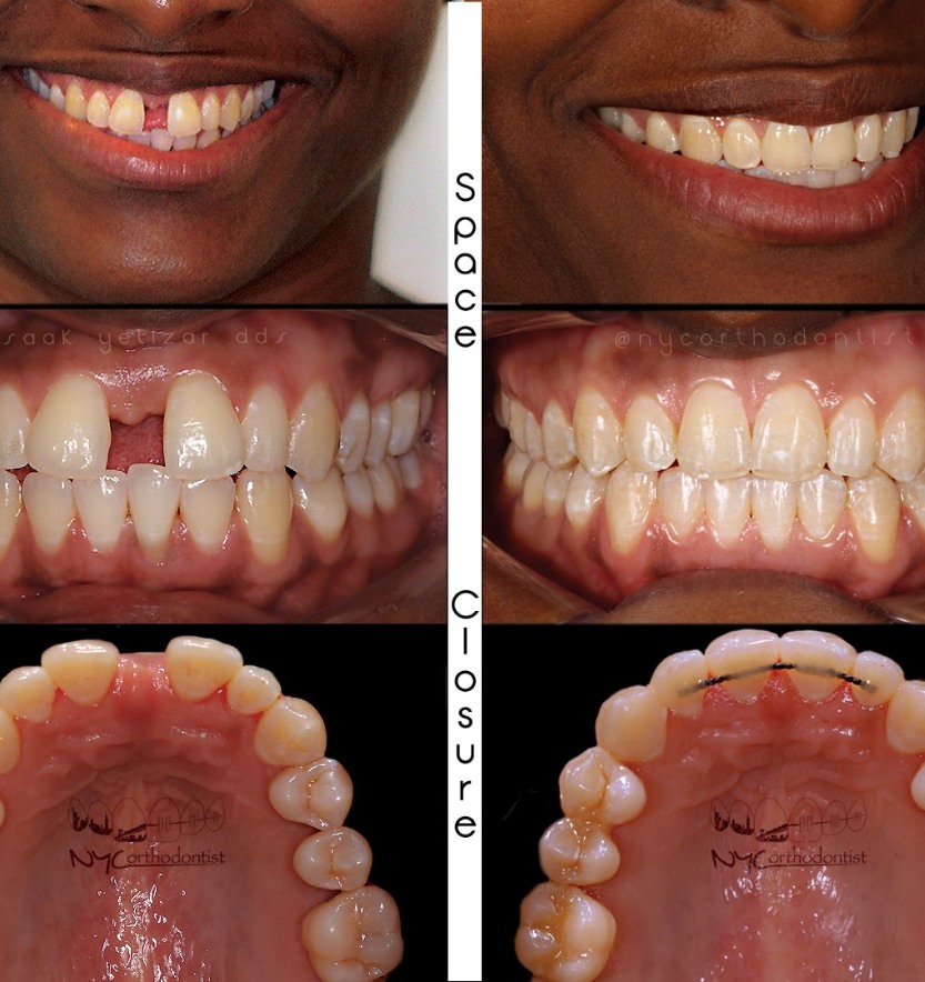 Smile before and after treatment for uneven tooth spacing