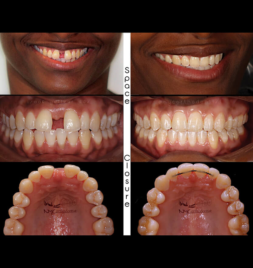 Smile before and after treatment for uneven tooth spacing