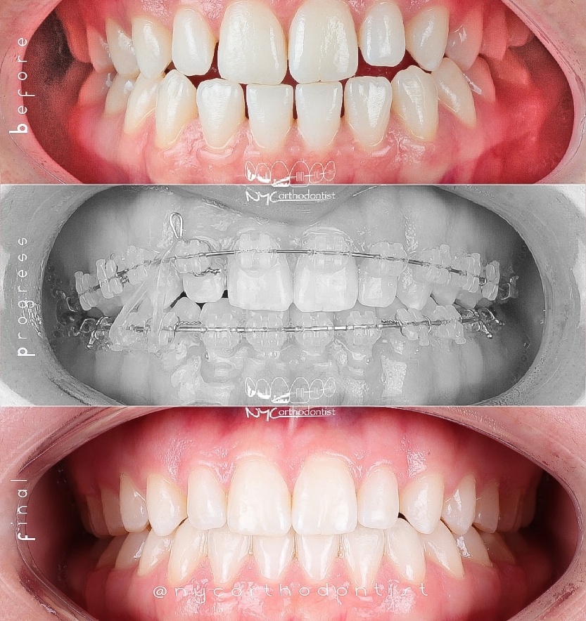 Smile before during and after uneven tooth spacing treatment