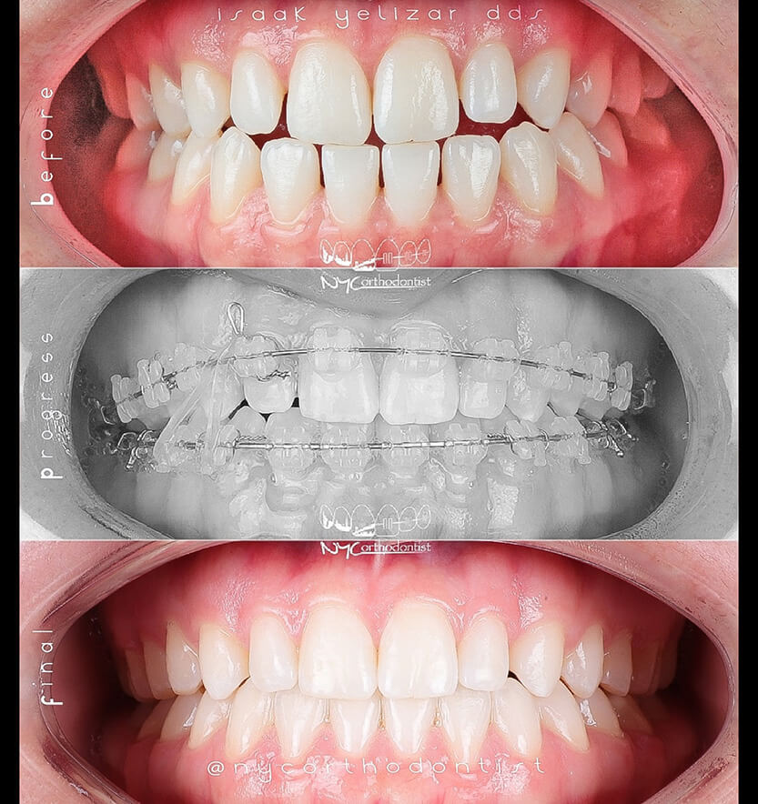 Smile before during and after uneven tooth spacing treatment