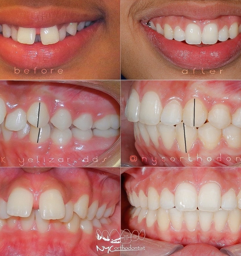 Patient's smile before and after treatment for uneven tooth spacing