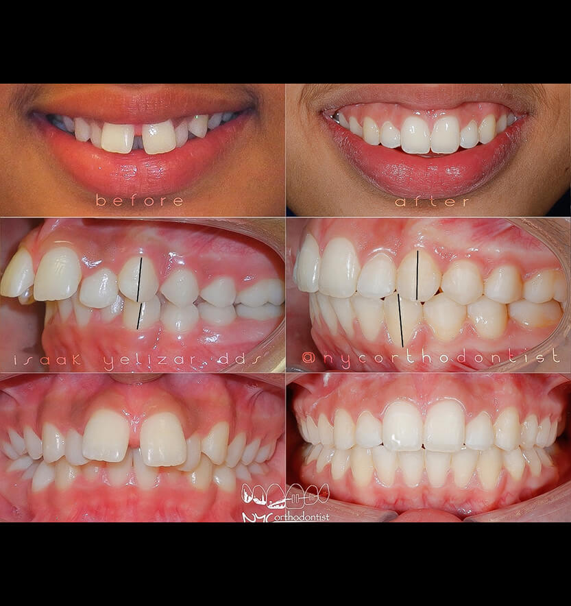 Patient's smile before and after treatment for uneven tooth spacing