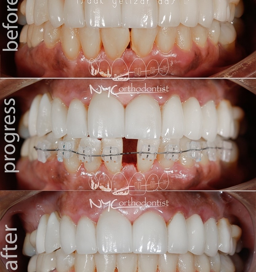 Smile before during and after treatment for uneven tooth spacing