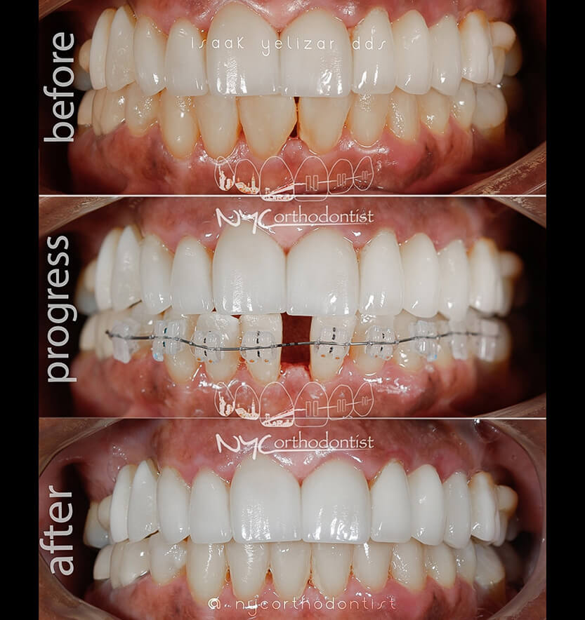 Smile before during and after treatment for uneven tooth spacing