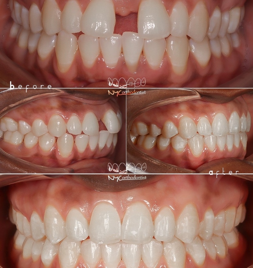 Front and side view of smile before and after treatment for uneven tooth spacing