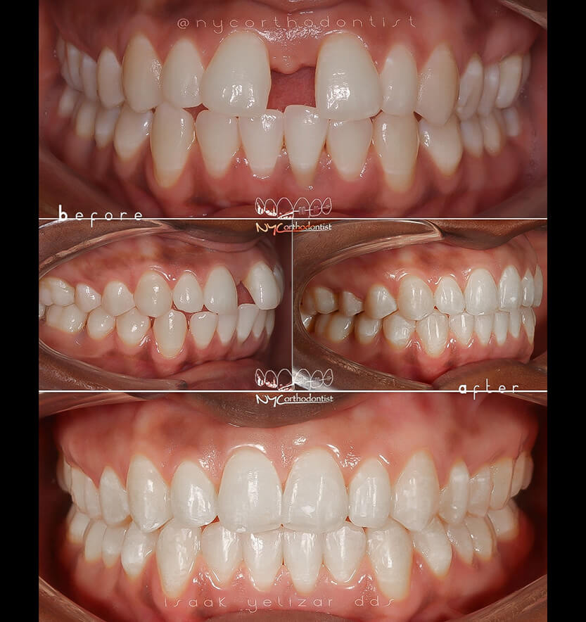 Front and side view of smile before and after treatment for uneven tooth spacing