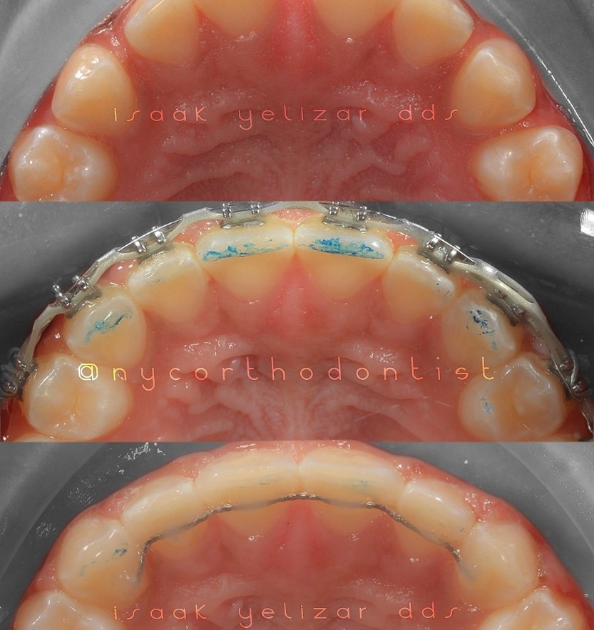 Patient's smile before during and after treatment for uneven tooth spacing