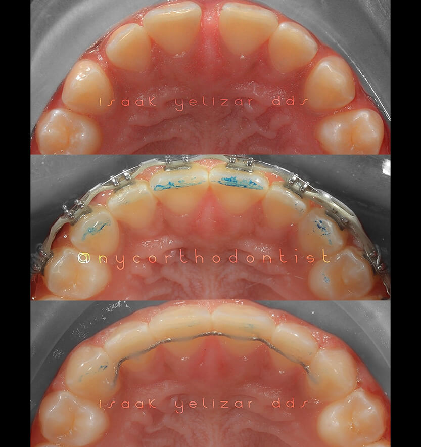 Patient's smile before during and after treatment for uneven tooth spacing