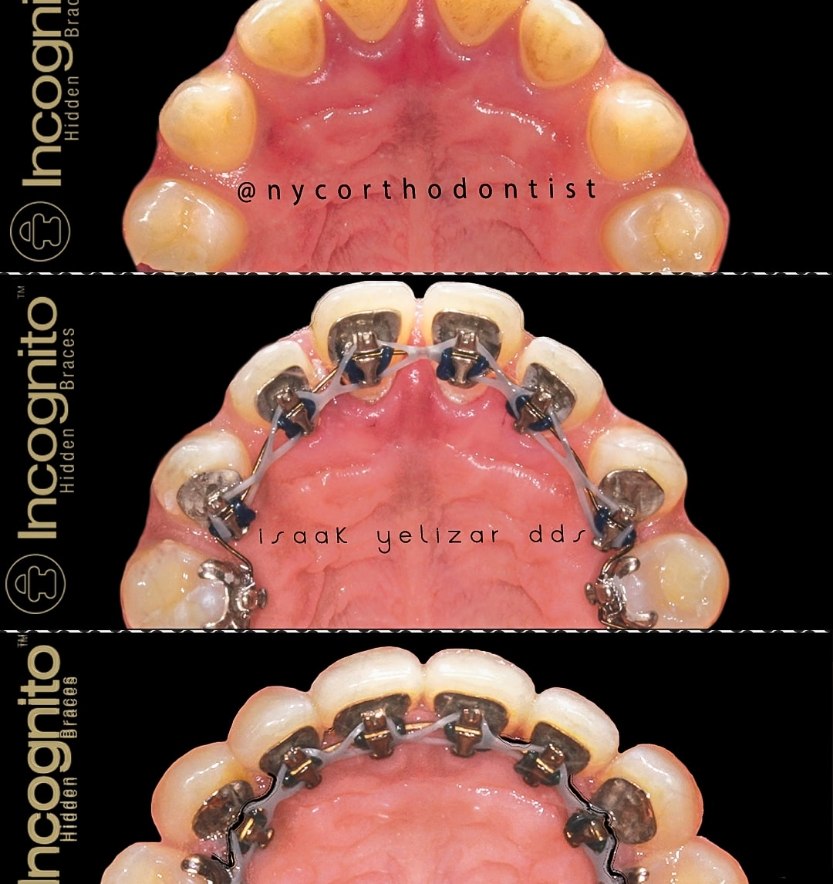 Inside of bottom teeth before during and after treatment for uneven tooth spacing