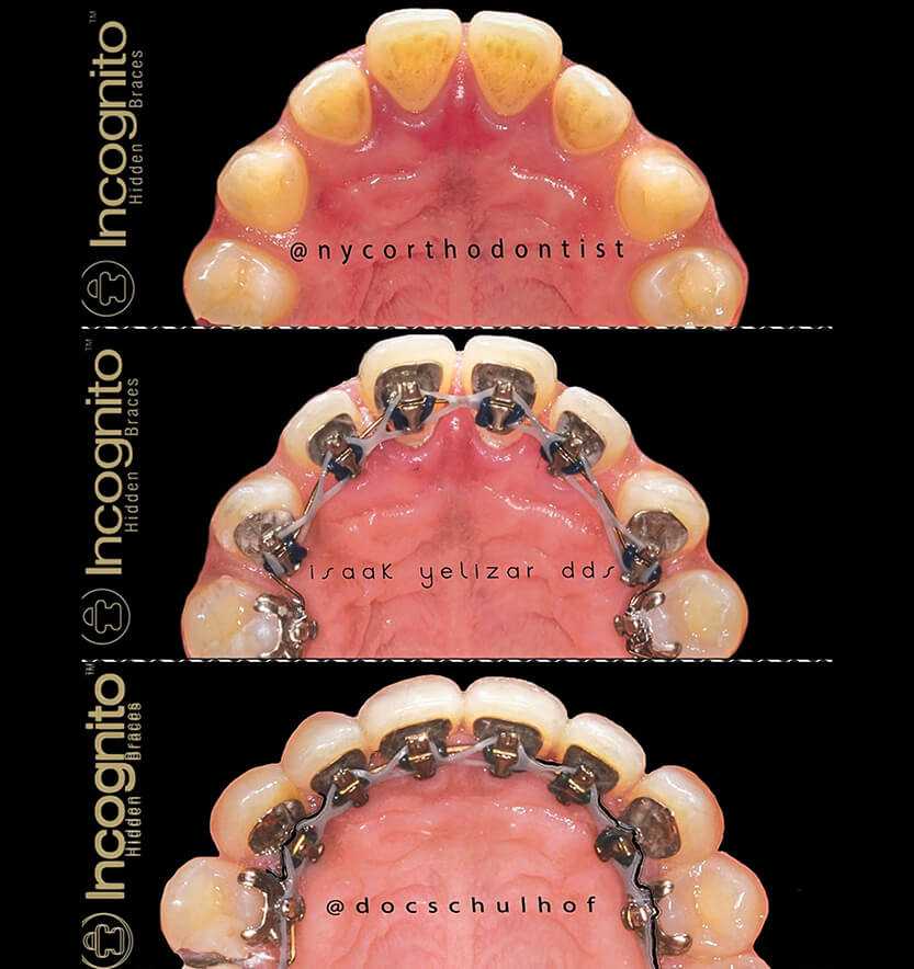 Inside of bottom teeth before during and after treatment for uneven tooth spacing