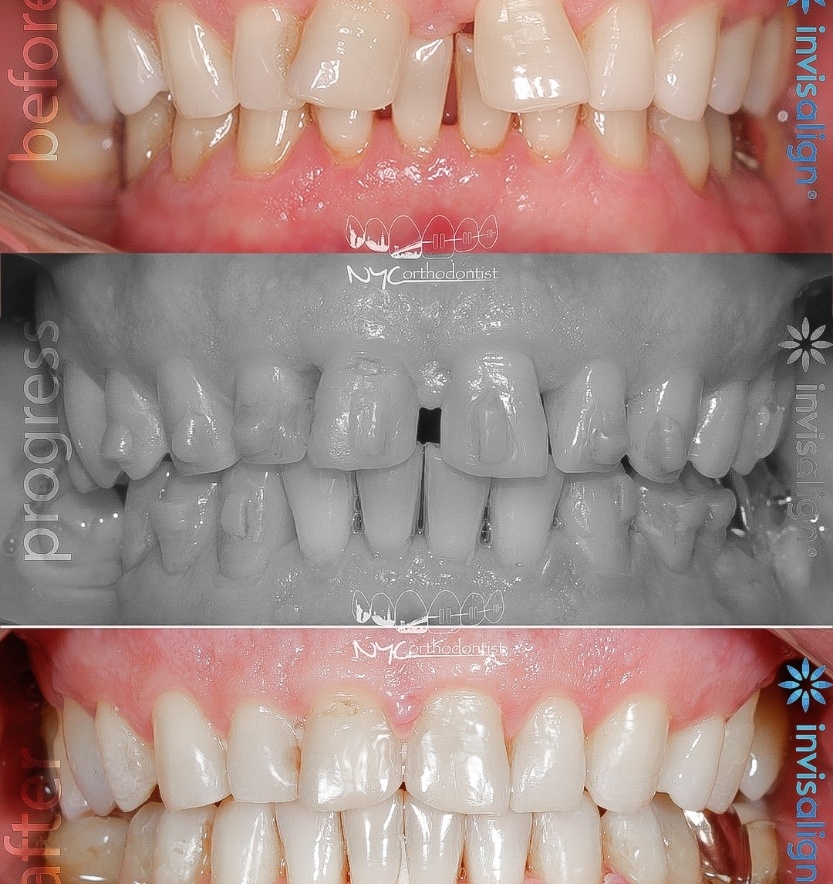 Closeup of smile before during and after treatment for uneven tooth spacing