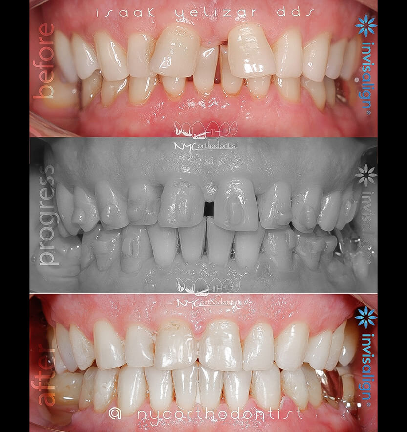 Closeup of smile before during and after treatment for uneven tooth spacing