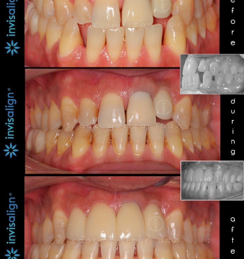 Patient's smile before during and after Invisalign treatment for uneven tooth spacing