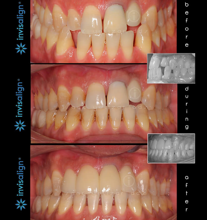 Patient's smile before during and after Invisalign treatment for uneven tooth spacing