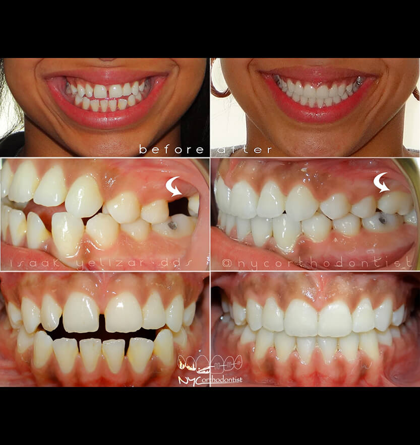 Smile before and after uneven tooth spacing treatment