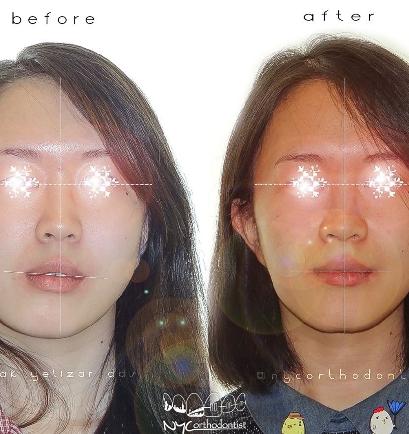Patient before and after surgical bite alignment