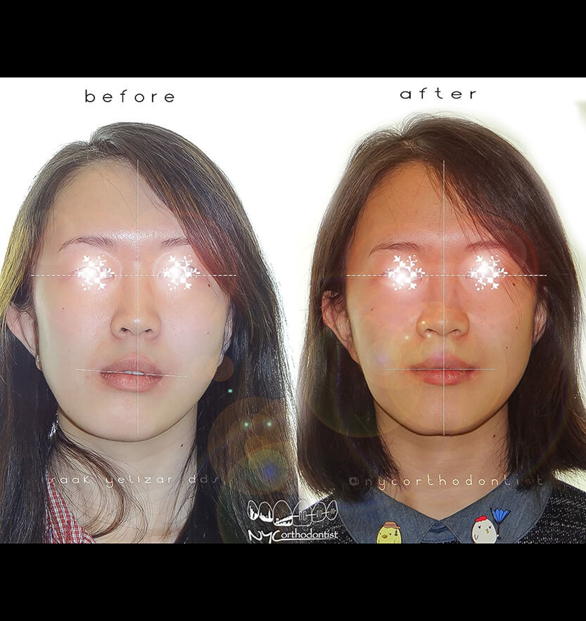 Patient before and after surgical bite alignment