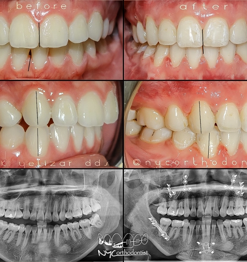 Front and side of smile and x-rays of teeth before and after surgical bite alignment