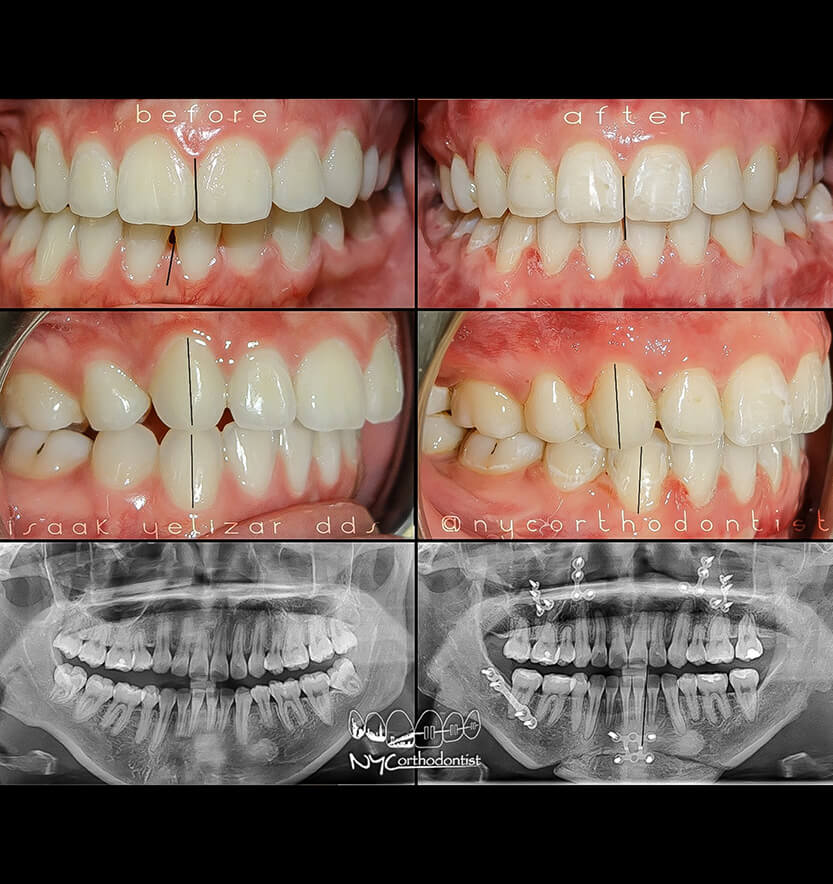 Front and side of smile and x-rays of teeth before and after surgical bite alignment
