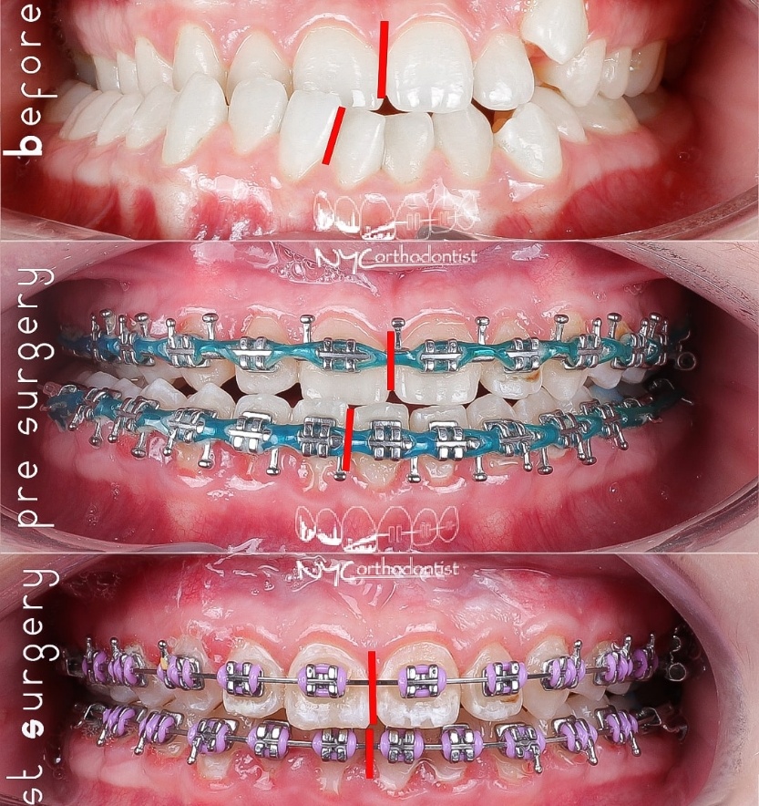Smile before during and after surgical bite alignment