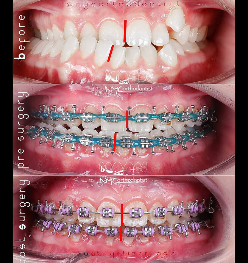 Smile before during and after surgical bite alignment