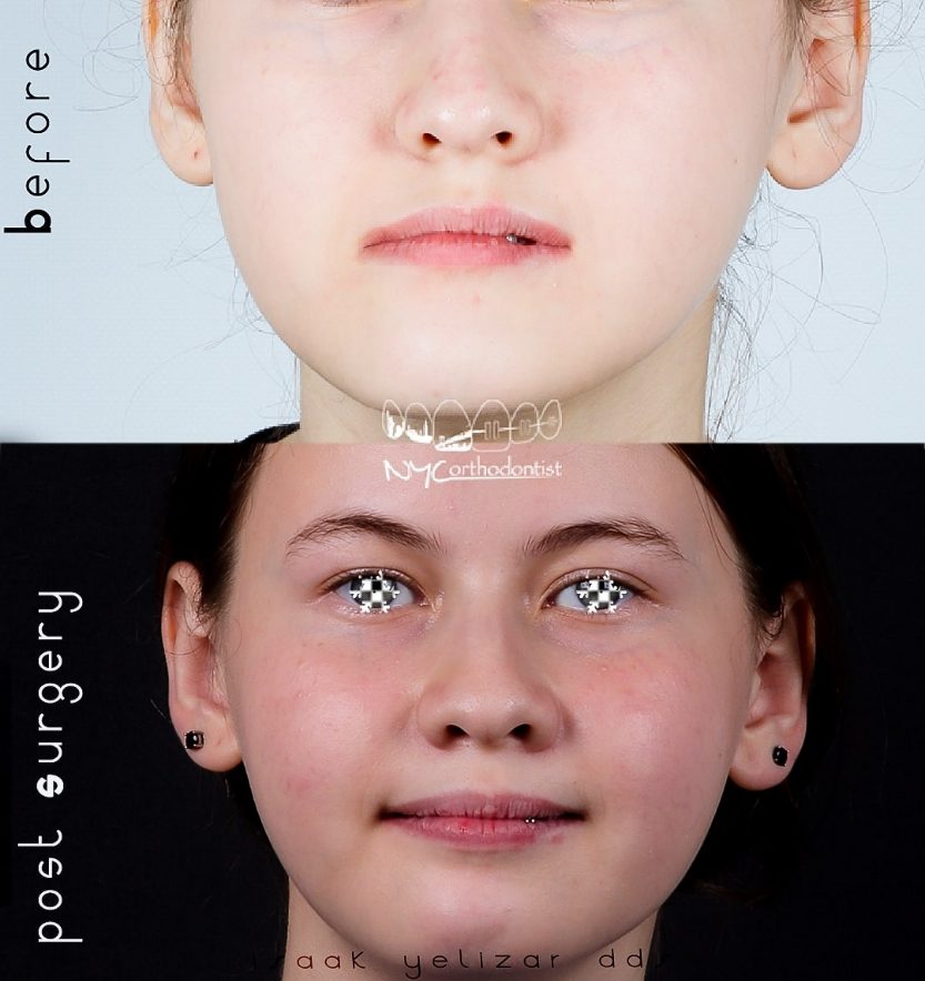 Patient sharing smile before and after surgical bite alignment