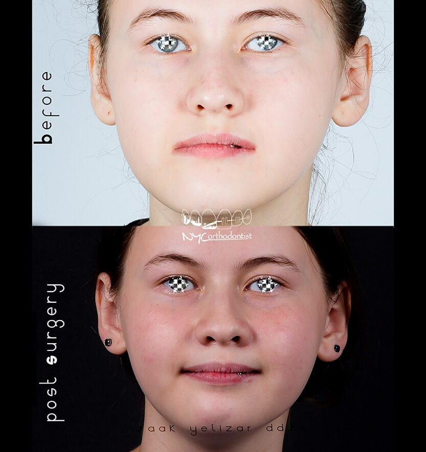 Patient sharing smile before and after surgical bite alignment