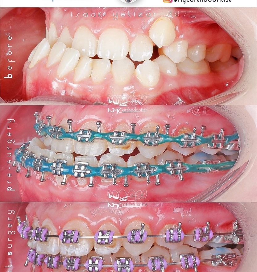 Side of patient's smile before during and after surgical bite alignment