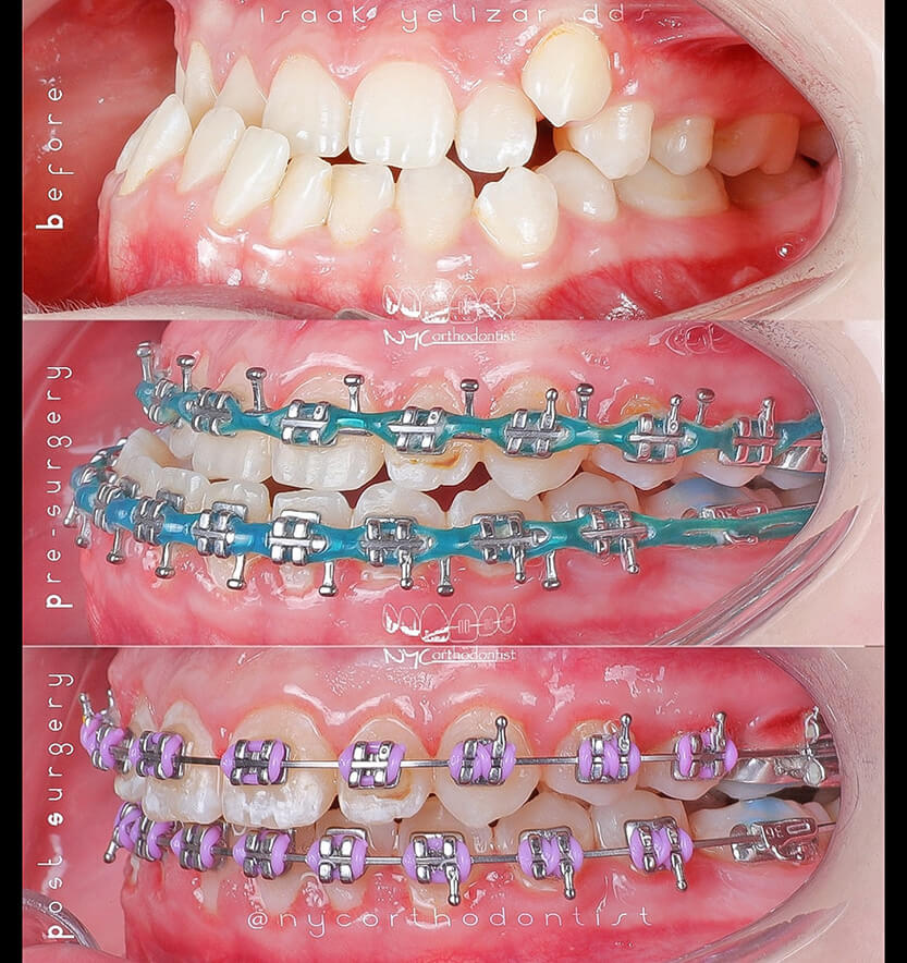 Side of patient's smile before during and after surgical bite alignment