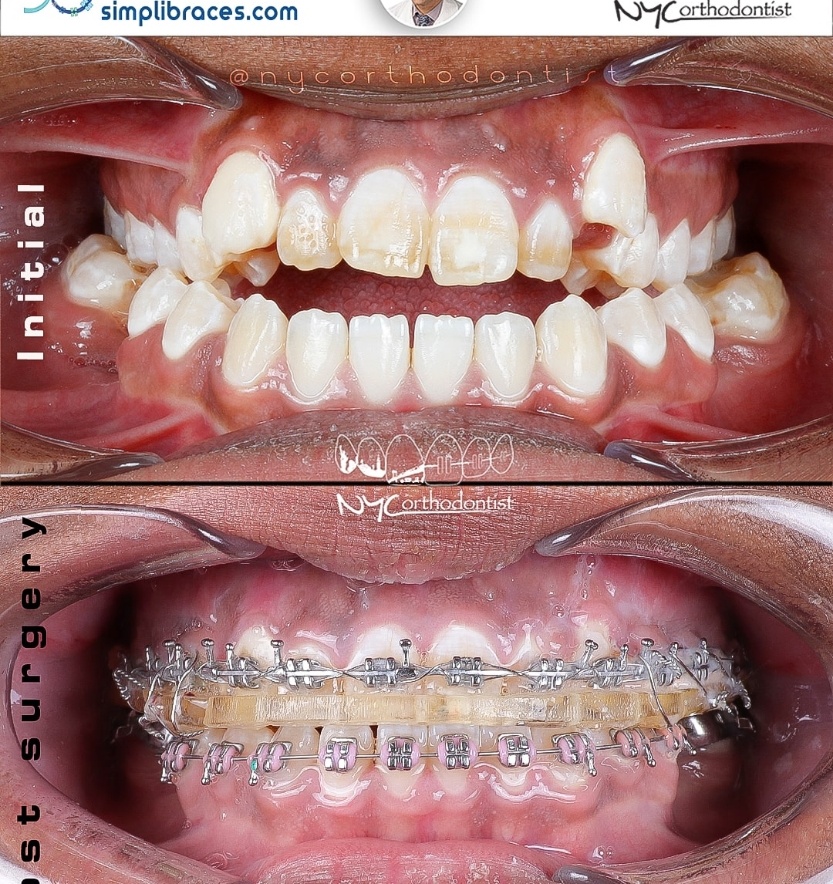 Closeup of smile before and after surgical bite alignment