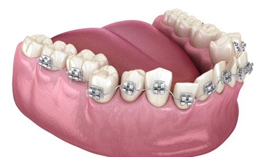 3D illustration for cost of traditional braces in Queens ? 