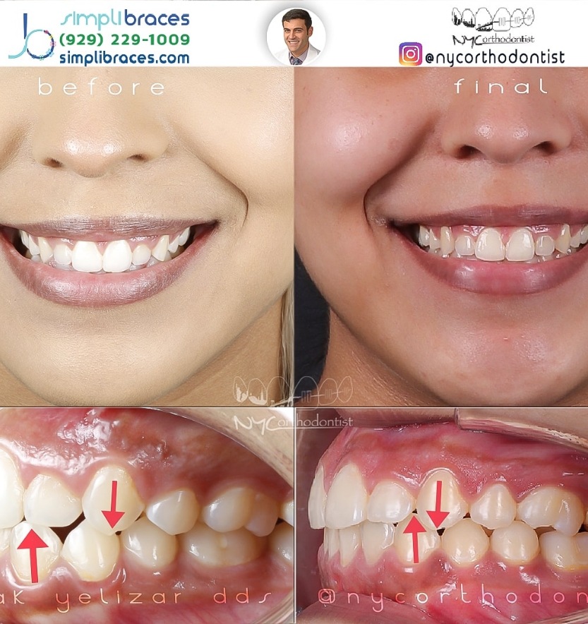 Front and side of smile before and after underbite treatment