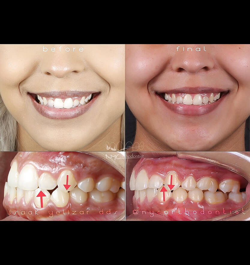 Front and side of smile before and after underbite treatment