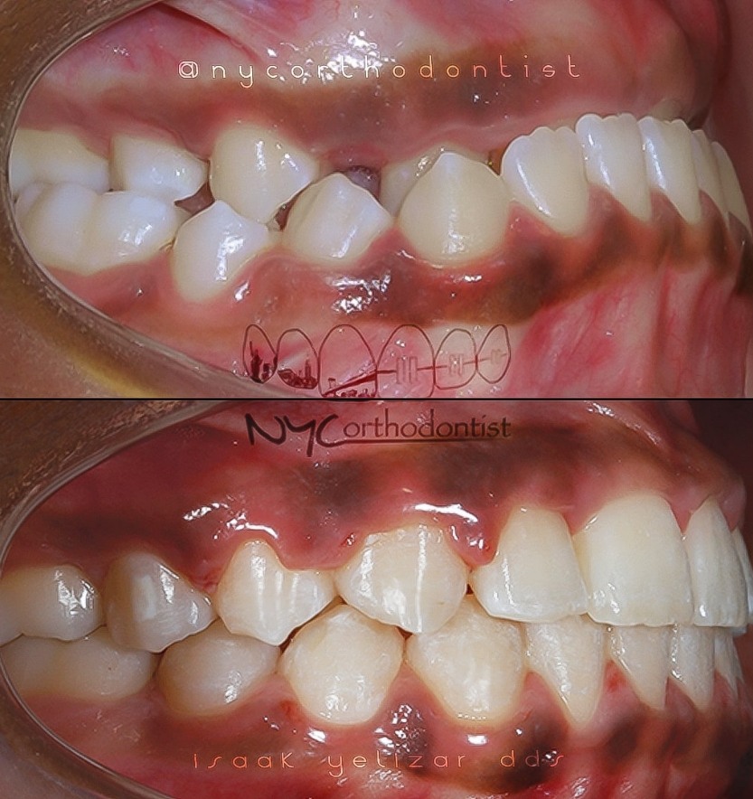 Side view of smile before and after underbite treatment