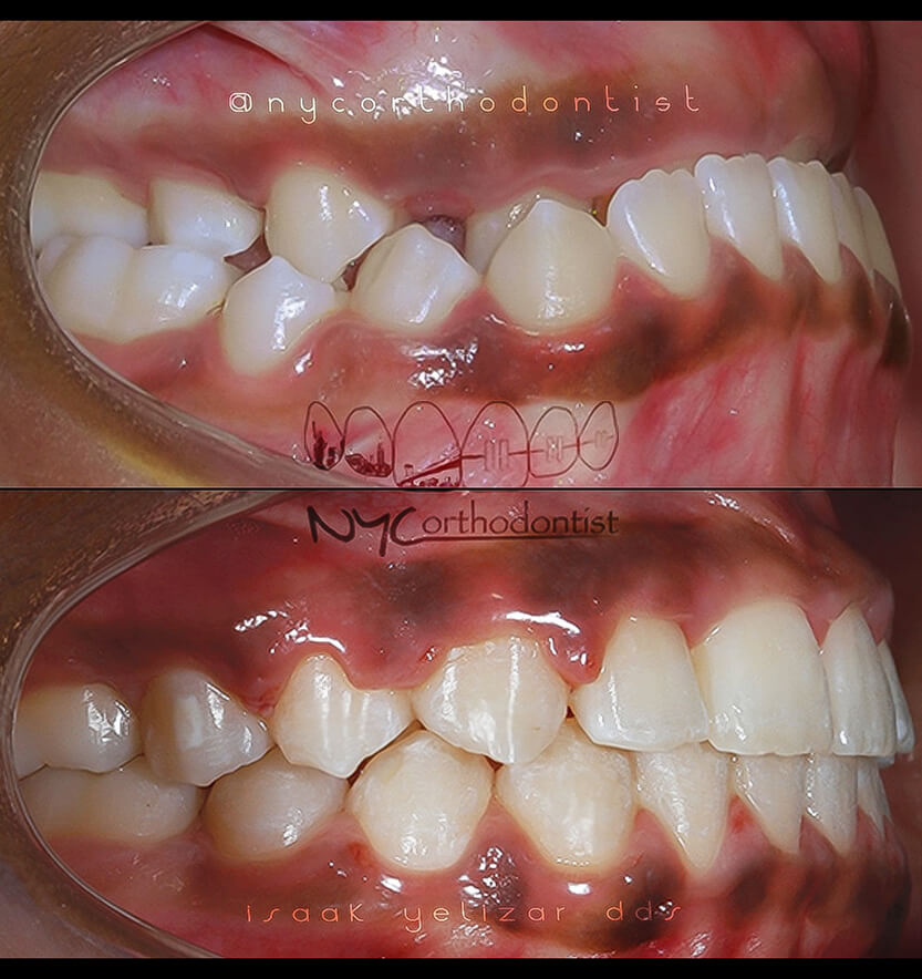 Side view of smile before and after underbite treatment